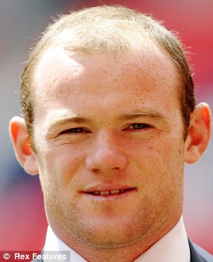 Wayne Rooney's well-known hair transplant.
